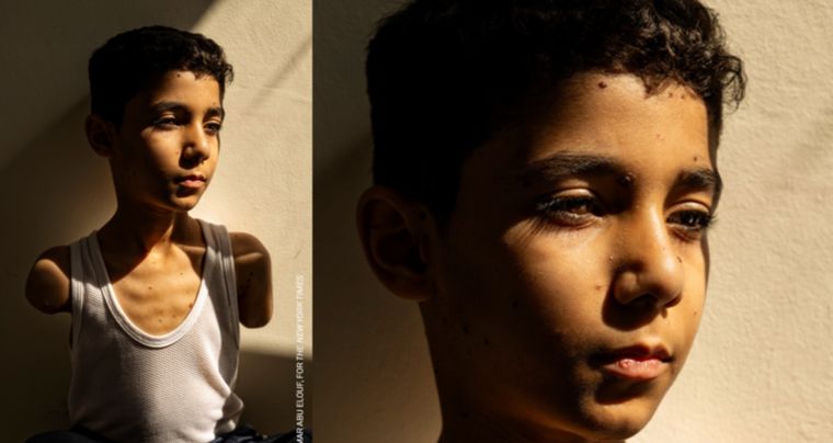 La foto de un niño palestino mutilado ganó el World Press Photo 2025. Foto: BBC.