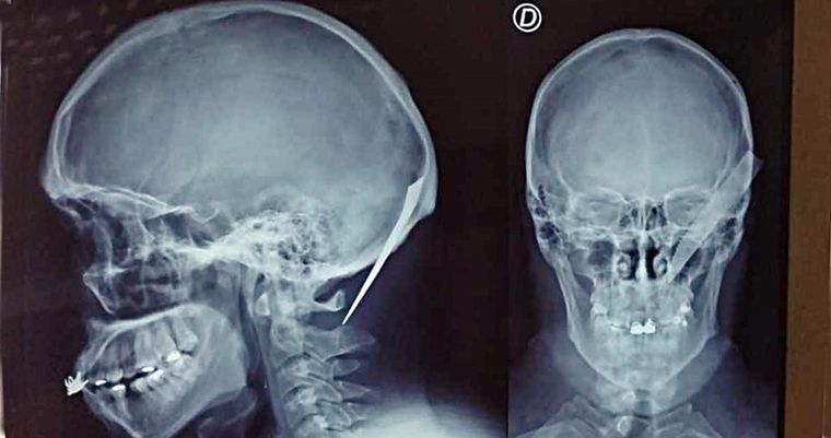 El hombre identificado como Oscar Zelada Jaldin fue operado y permanece fuera de peligro