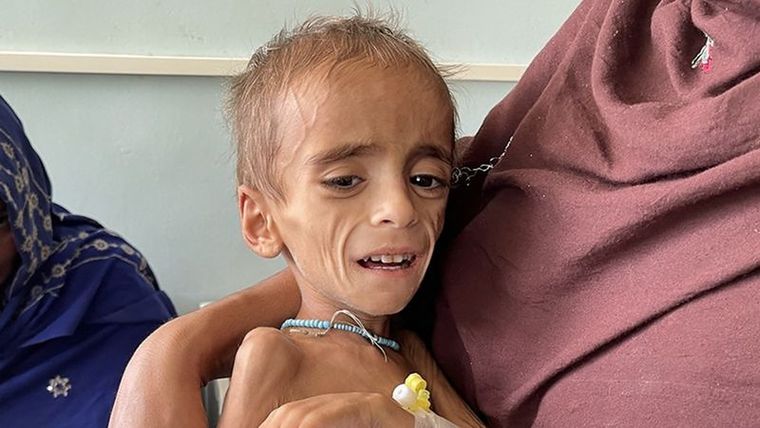 Un niño con desnutrición en Kandahar, en Octubre Foto: GETTY IMAGES
