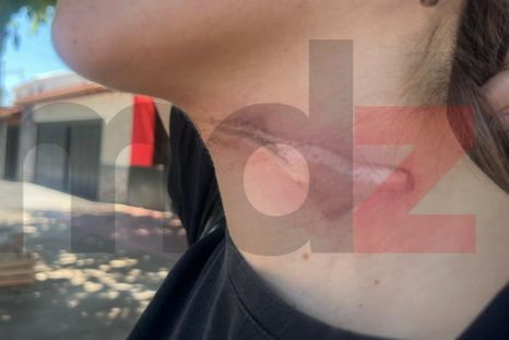 El cuello de la joven herida tras chocar con un cable suelto en Godoy Cruz. El cuello de la joven herida tras chocar con un cable suelto en Godoy Cruz.