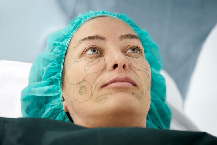 El estiramiento facial requiere hacer incisiones a ambos lados del rostro.