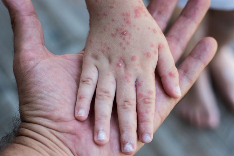 Mano-pie-boca es una enfermedad provocada por un contagioso virus. Foto: Shutterstock