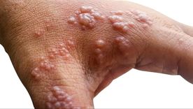 El Gobierno informó que ya son 5 los infectados con viruela del mono Foto: The Health Site