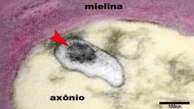 La imagen muestra un axón de una neurona en el cerebro de un niño con síndrome inflamatorio multisistémico pediátrico (SIM-P). La flecha señala al virus SARS-CoV-2 en una vesícula en el citoplasma del axón. Foto: ELIA CALDINI