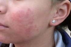 nuevo tratamiento para variedad agresiva de urticaria