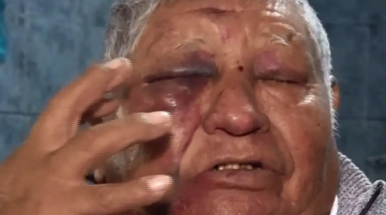 Hilario perdió parcialmente la visión en uno de sus ojos. Hilario perdió parcialmente la visión en uno de sus ojos.