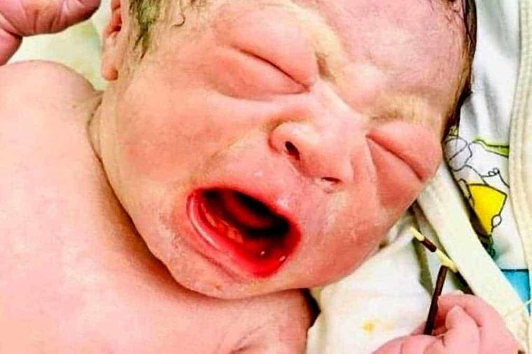 El bebé nació con el DIU de su madre en la mano