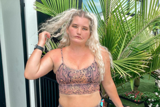 es modelo, no puede sonreir y usa su fama para visibilizar la enfermedad rara que padece