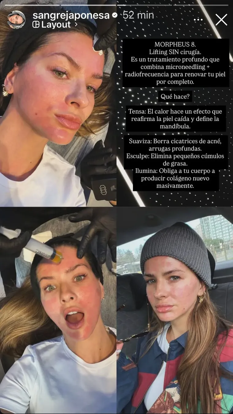 Rostro enrojecido y sin filtros: la cruda realidad del post-tratamiento estético en Turquía. Rostro enrojecido y sin filtros: la cruda realidad del post-tratamiento estético en Turquía.