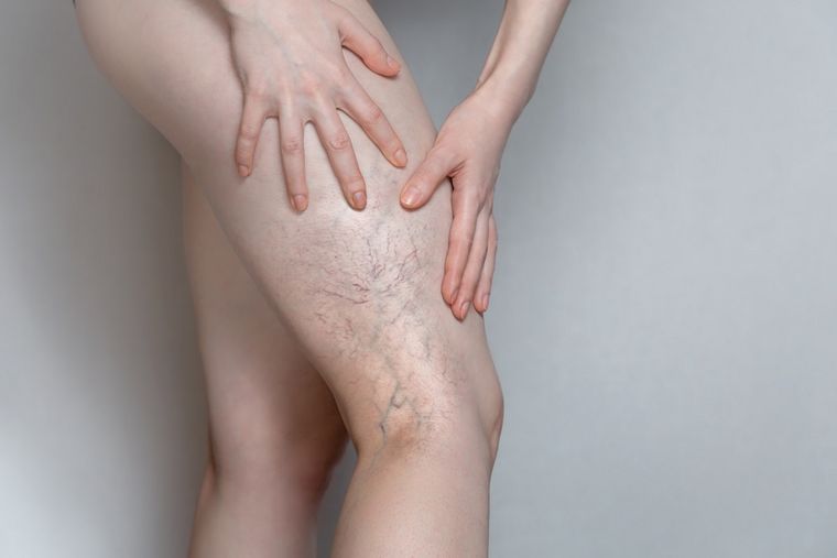Las arañitas o varices afectan más a las mujeres que a los hombres. Foto: Shutterstock