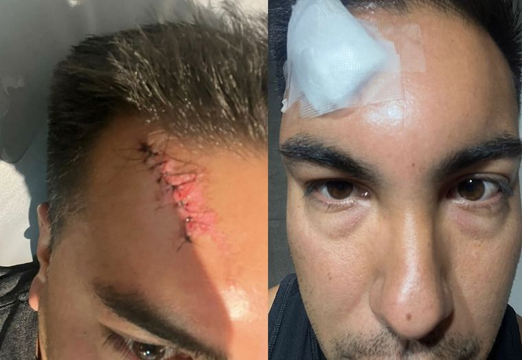 El hincha de Godoy Cruz publicó su testimonio en X junto a fotos de su lesión. Foto: X