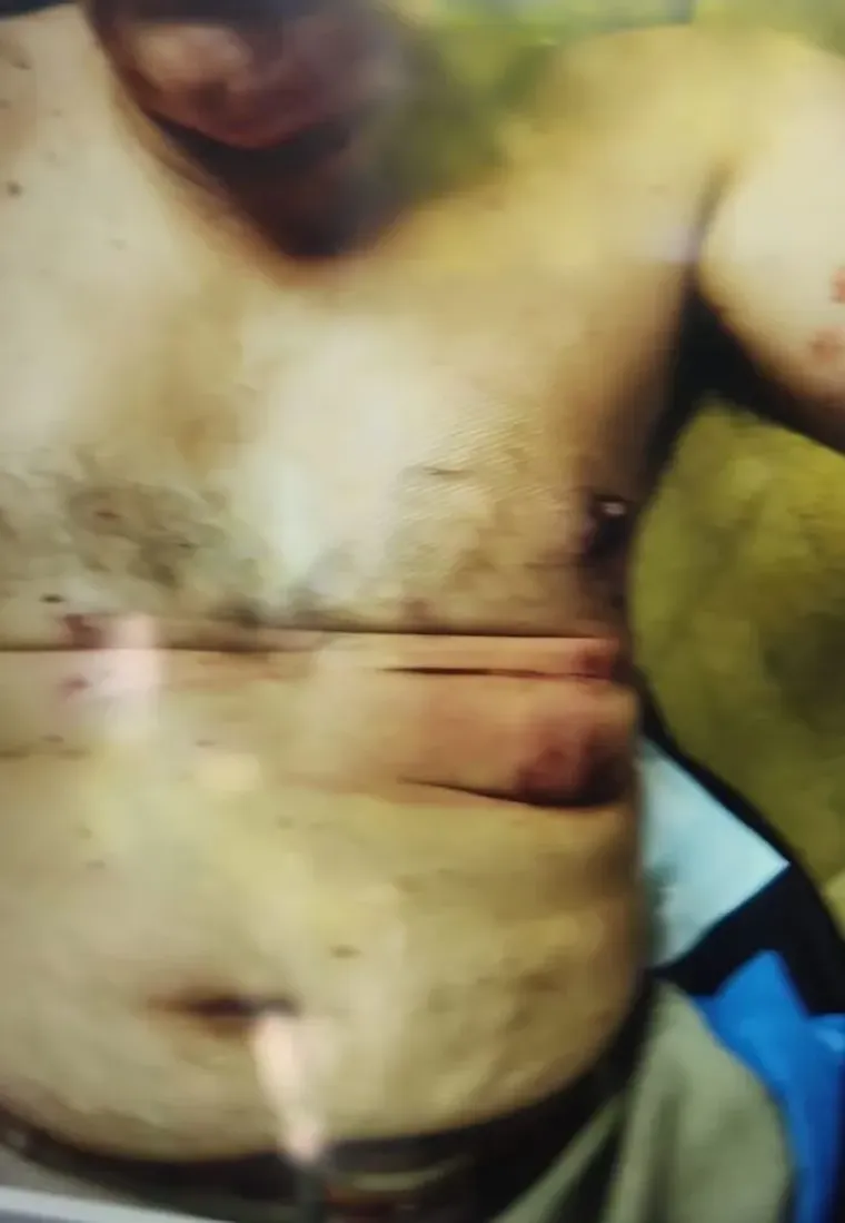 Las lesiones que recibió uno de los gendarmes heridos. Las lesiones que recibió uno de los gendarmes heridos.