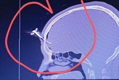 El agresor le clavó una llave de auto en la cabeza a un exfutbolista y padre de una jugadora en un torneo sub 16 en Berazategui. El agresor le clavó una llave de auto en la cabeza a un exfutbolista y padre de una jugadora en un torneo sub 16 en Berazategui.