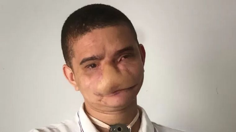 Samuel Rodrigues muestra las marcas dejadas por accidente. Hoy respira por traqueotomía. Foto: ARCHIVO PERSONAL