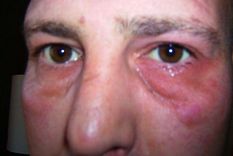 Un ataque comienza con el ojo izquierdo de Daren lloroso y caído