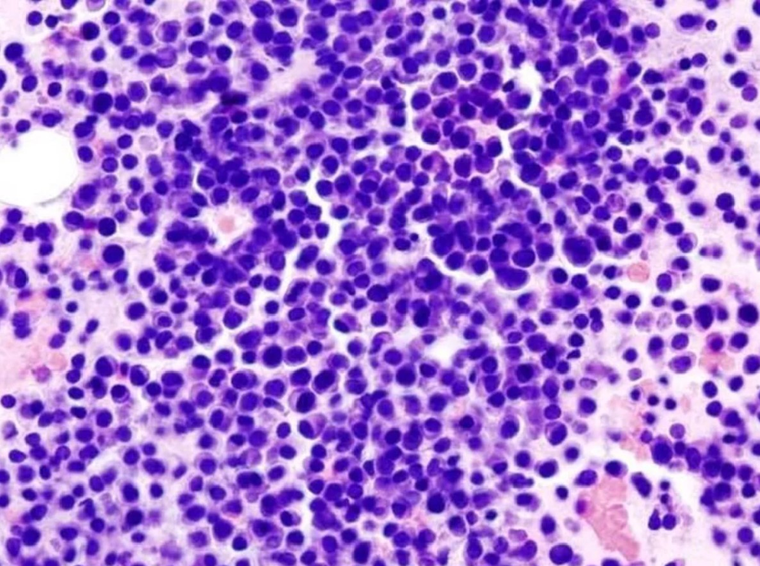 El mieloma múltiple es el segundo cáncer más común en la sangre y ahora apareció un nuevo avance que podría prolongar la vida del paciente. Foto: Noticias Argentinas