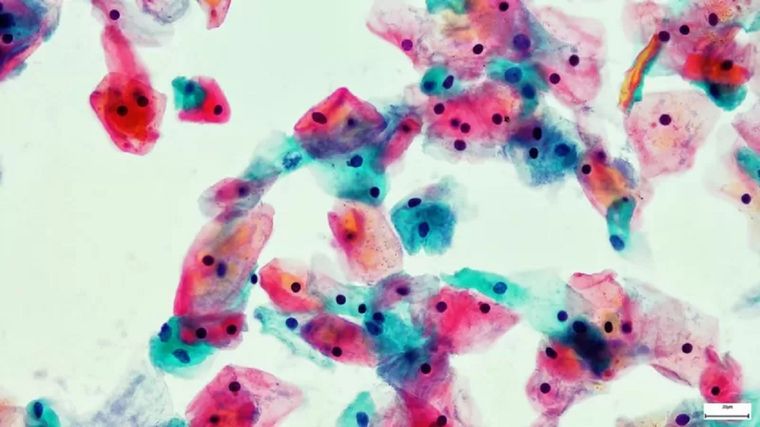 Un frotis citológico de vagina (tinción de Papanicolaou, x 1000), un ejemplo de un examen que salva vidas. Foto: GETTY IMAGES