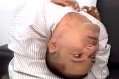 La rara condición del hombre que nació con la cabeza al revés