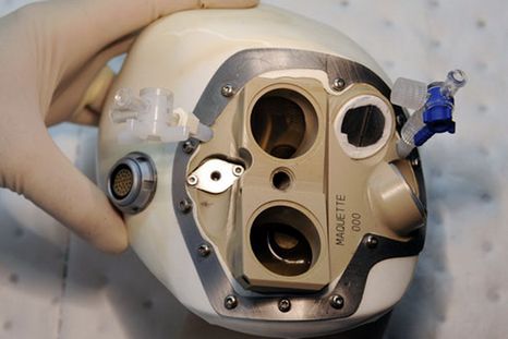 Segundo trasplantado con un corazón artificial es dado de alta
