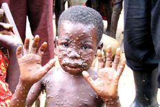 La enfermedad es contagiosa. Foto: TheGuardianNigeria.