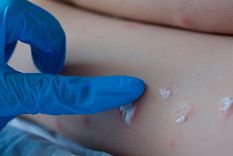 la viruela del mono crece en europa: ya hay 10 paises con contagios