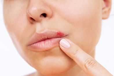 MDZol | La odontóloga Roxana Spedaletti explicó de que manera se contagian los herpes en la boca Foto: Freepik