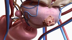 El 70% de los hombres no se realiza los controles hasta que no presentan síntomas de cáncer de próstata. El 70% de los hombres no se realiza los controles hasta que no presentan síntomas de cáncer de próstata.