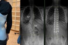 Paciente con corset y placa de un antes y después de la cirugía. Foto: Martín Estefan