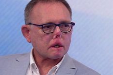 Estuve muy, muy cerca de morir: el hombre que perdió las piernas, los dedos y parte de la cara por un arañazo y lamida de su perro