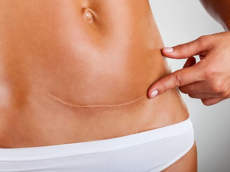 ¡Adiós cicatrices!