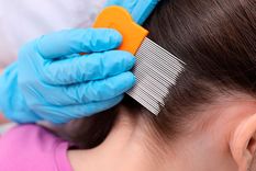 Dile adiós a los piojos con estos remedios naturales Foto: Shutterstock