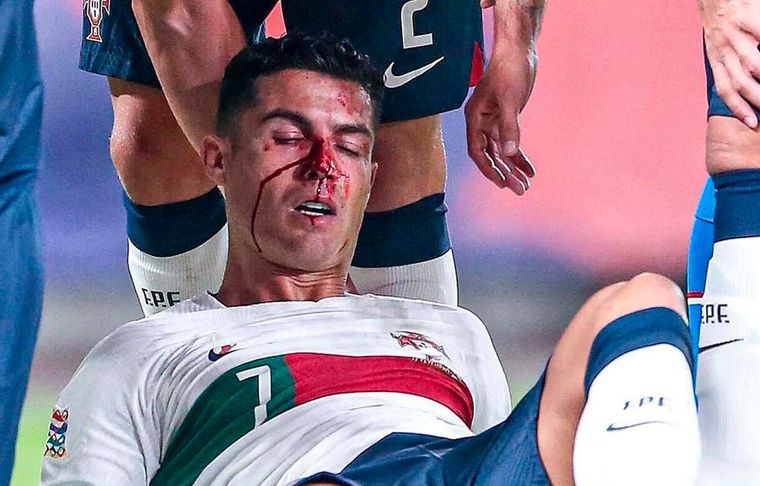 Cristiano Ronaldo El portugués chocó con el arquero rival y quedó ensangrentado.