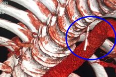 En la radiografía se ve claramente la aguja. Foto: Crónica