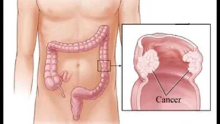 Con 13.500 casos detectados al año y 20 muertes por día, el cáncer colorrectal es el segundo cáncer en frecuencia y en cantidad de muertes en nuestro país. Foto: Gentileza SACP