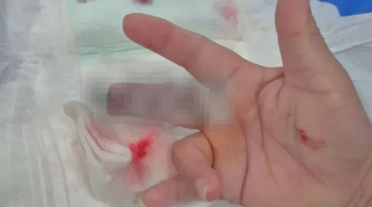 Así quedó la mano de la enfermera. Así quedó la mano de la enfermera.