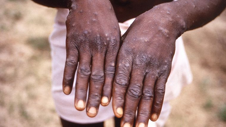Uno de los síntomas característicos de la enfermedad son las  erupciones o lesiones en la piel