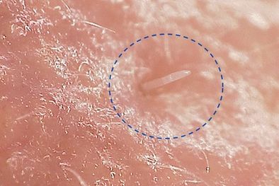 MDZol | El Demodex follicularum, como se le llama científicamente, tiene solo 0,3 mm de largo Foto: UNIVERSITY OF READING