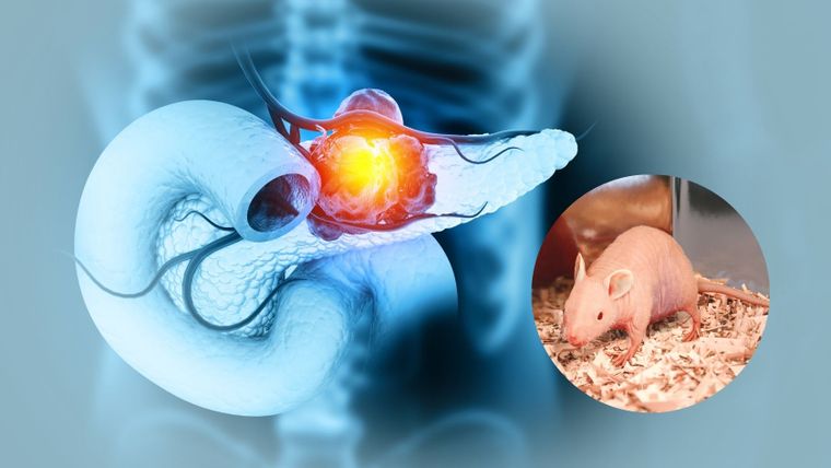 El adenocarcinoma ductal de páncreas -el tipo más habitual de cáncer de páncreas y el de peor pronóstico- suele diagnosticarse demasiado tarde. El adenocarcinoma ductal de páncreas -el tipo más habitual de cáncer de páncreas y el de peor pronóstico- suele diagnosticarse demasiado tarde.