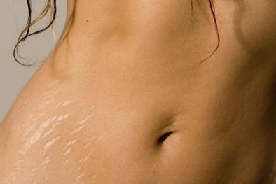 MDZol | ¿Cómo eliminar las estrías? la solución perfecta leche de almendras y uvas