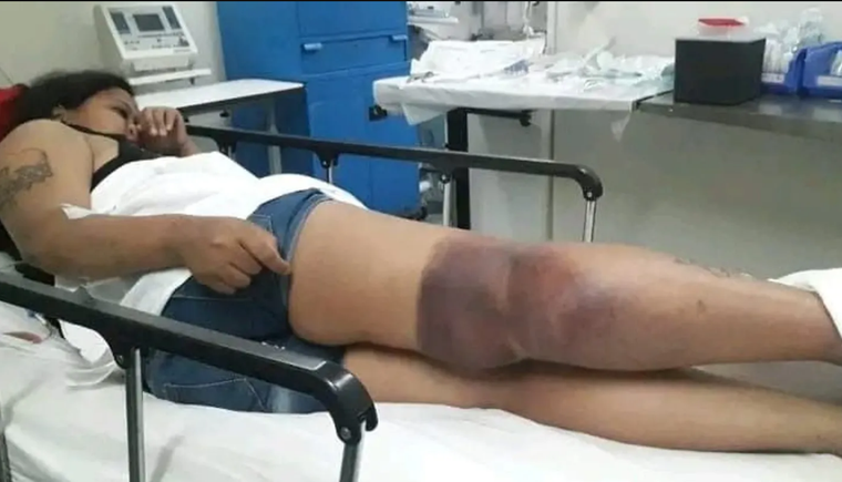 Así quedó la mujer tras recibir la descarga eléctrica