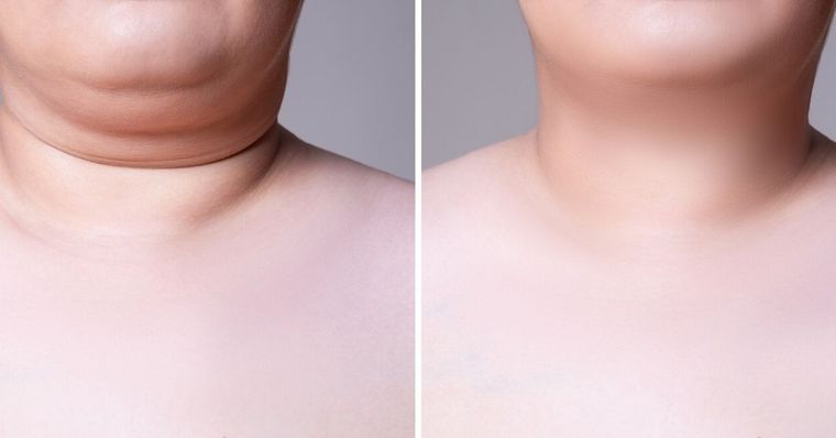 ¿Te molesta la papada?