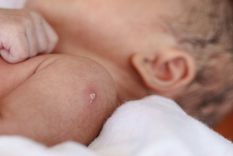 La mayoría de los vacunados con BCG experimentan una reacción en el lugar de la inyección que se considera normal y se denomina cicatriz de BCG. Foto: GETTY IMAGES