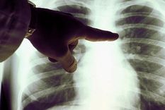 Sin medicación específica adicional, el linfoma de un paciente que contrajo el coronavirus desapareció, según una investigación. Foto: GETTY IMAGES