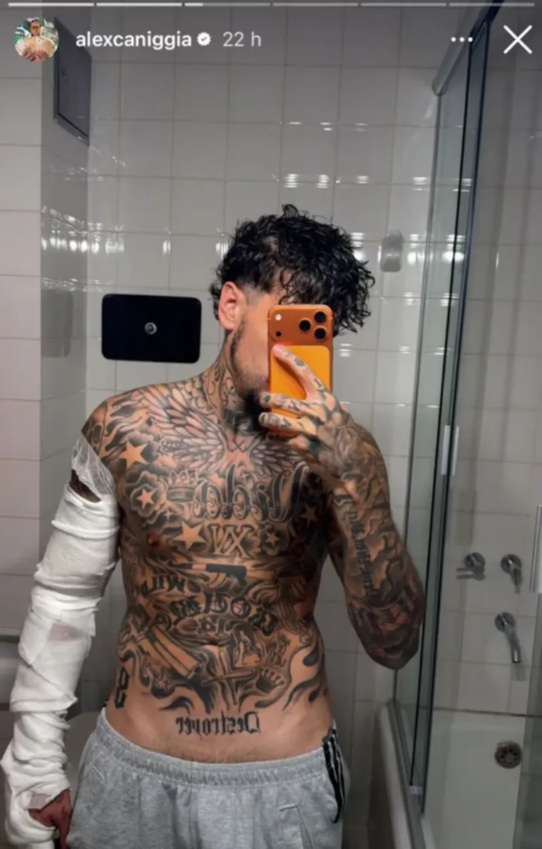 Alex Caniggia durante la primera sesión de láser para borrar sus icónicos tatuajes. Alex Caniggia durante la primera sesión de láser para borrar sus icónicos tatuajes.