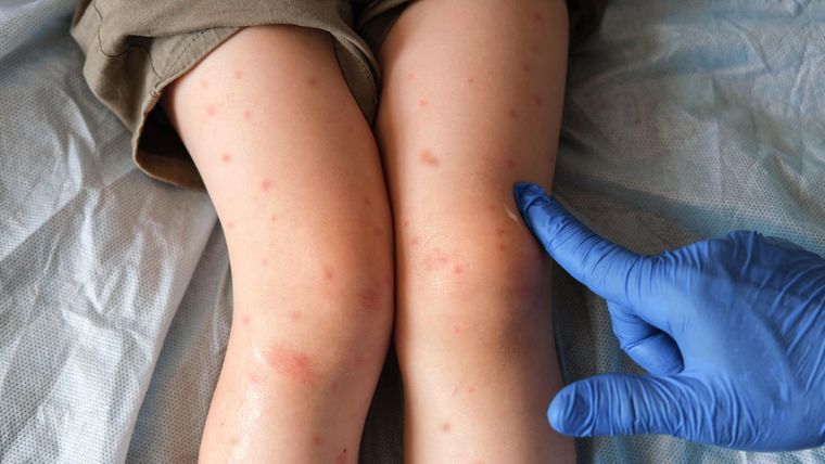 En lo que va de 2025, Canadá contabiliza más de 3.800 casos de sarampión, más que EE.UU.