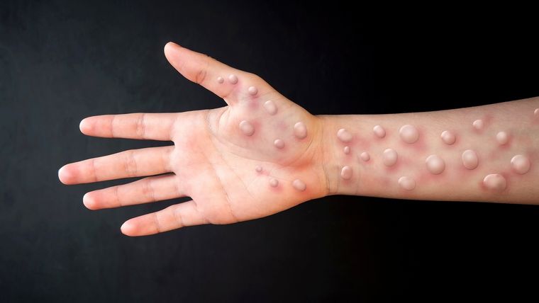 La región del Pacífico Occidental registró la mayoría de los casos de mpox en las últimas tres semanas debido al gran aumento en China Foto: Shutterstock