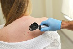 Una de las herramientas más eficaces para diagnosticar el melanoma en estadios iniciales es la observación atenta de la piel, sobre todo de los lunares. Foto: Shutterstock