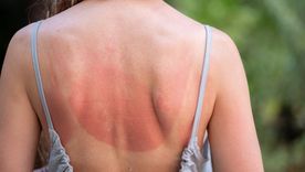 Evitar el sol en horarios críticos durante el verano reduce el riesgo de quemaduras. Foto: Shutterstock