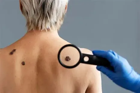 El Cáncer de Piel es una enfermedad que cuenta con mayores posibilidades de prevención y tratamiento. El Cáncer de Piel es una enfermedad que cuenta con mayores posibilidades de prevención y tratamiento.