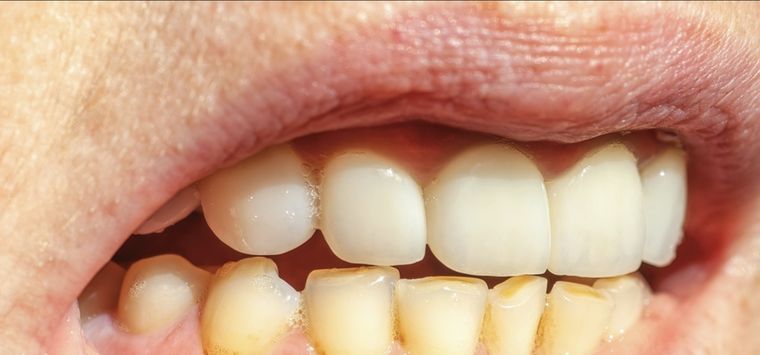 Previene el sarro con estos métodos caseros Foto: Shutterstock